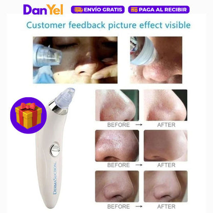 KIT DE CUIDADO FACIAL: PARCHES ANTIACNÉ+ 🎁 SUCCIÓN PROFESIONAL DE PUNTOS NEGROS GRATIS