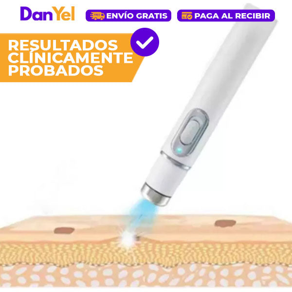 ✨ÚLTIMO DÍA 49% OFF🔥 PLUMA LÁSER ANTIACNÉ PORTÁTIL