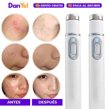 ✨ÚLTIMO DÍA 49% OFF🔥 PLUMA LÁSER ANTIACNÉ PORTÁTIL