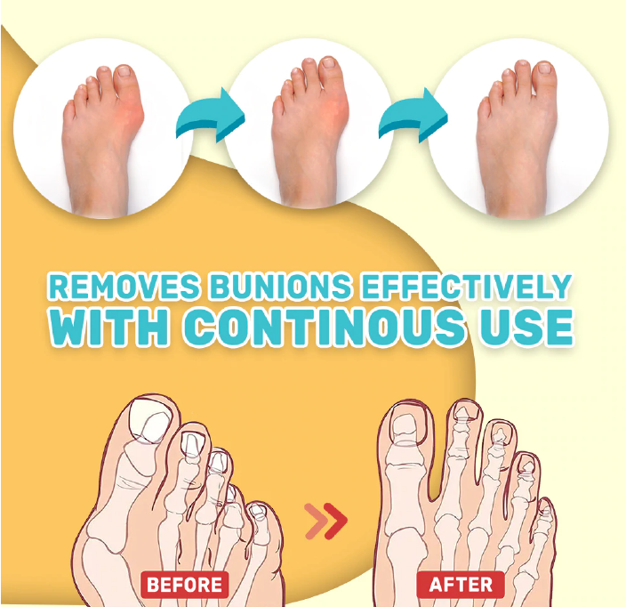 Crema para Pies | Alive Bunion