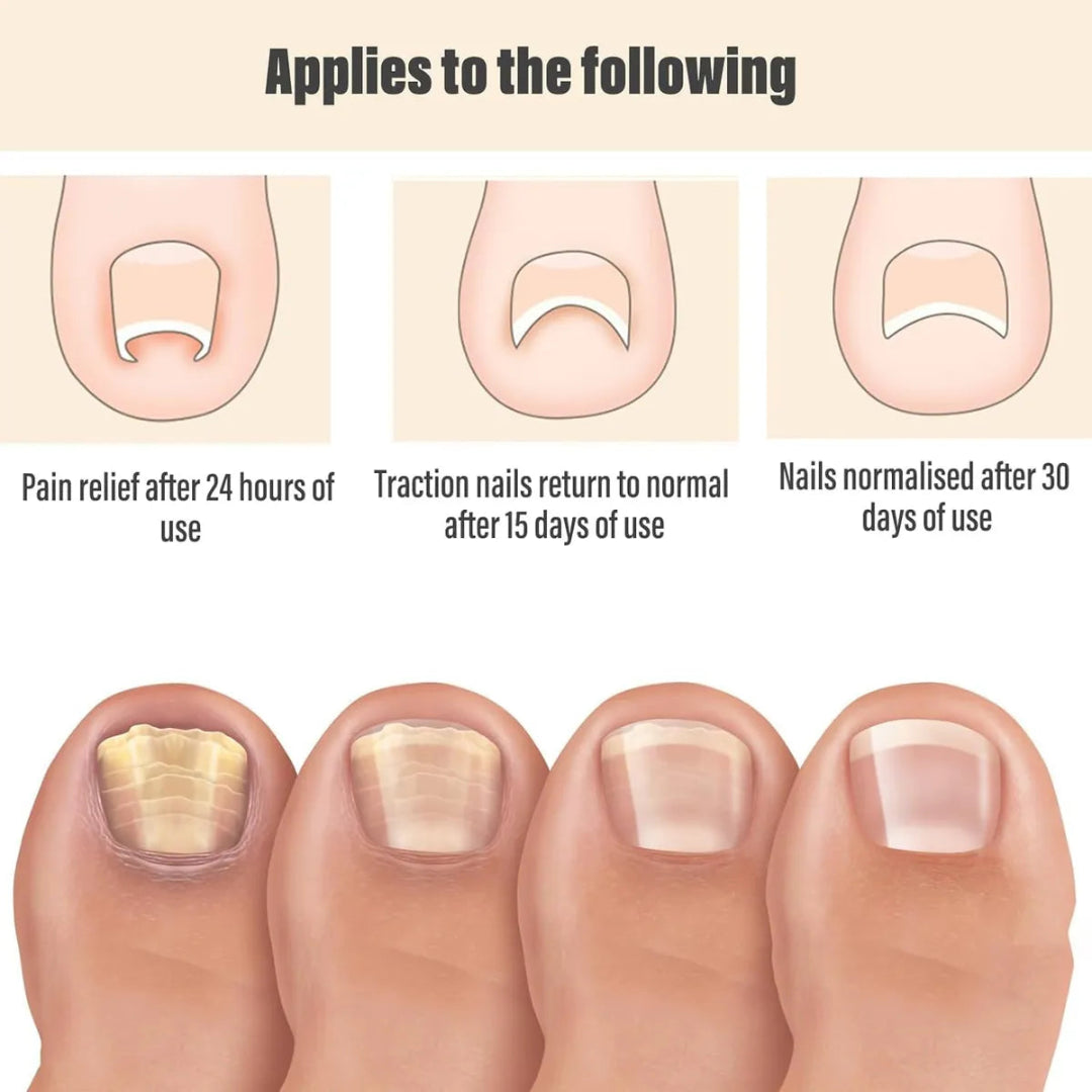 Parche Corrector de Uñas