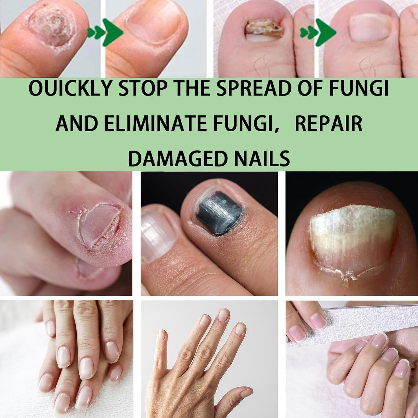Aceite Milagroso para Uñas | Dile adiós a los hongos en 7 días L